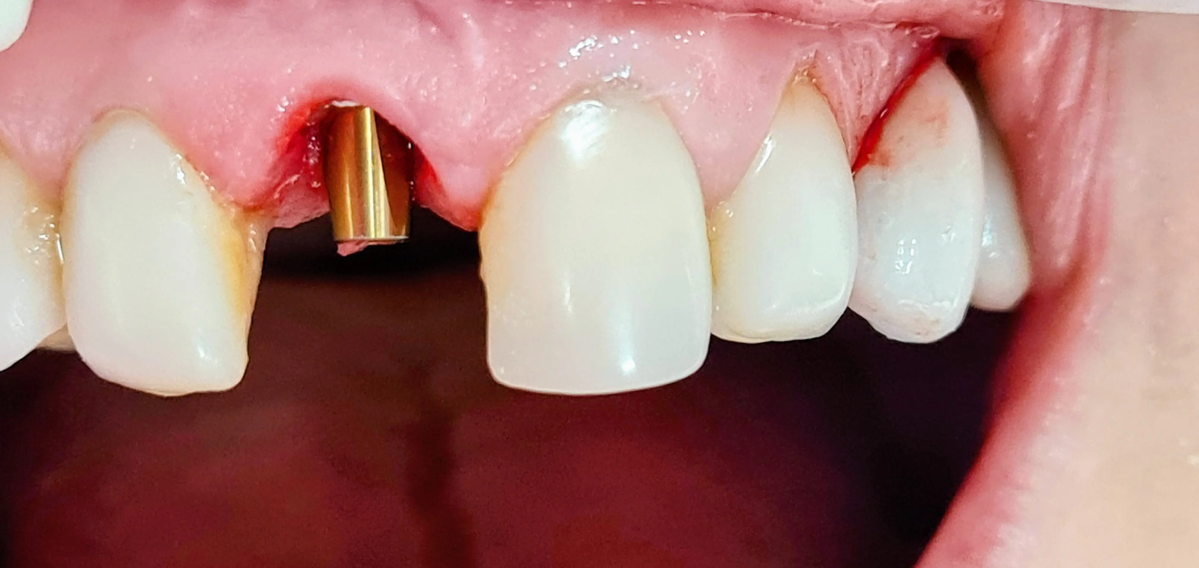 Implant dentar înainte - CadTech Dental București