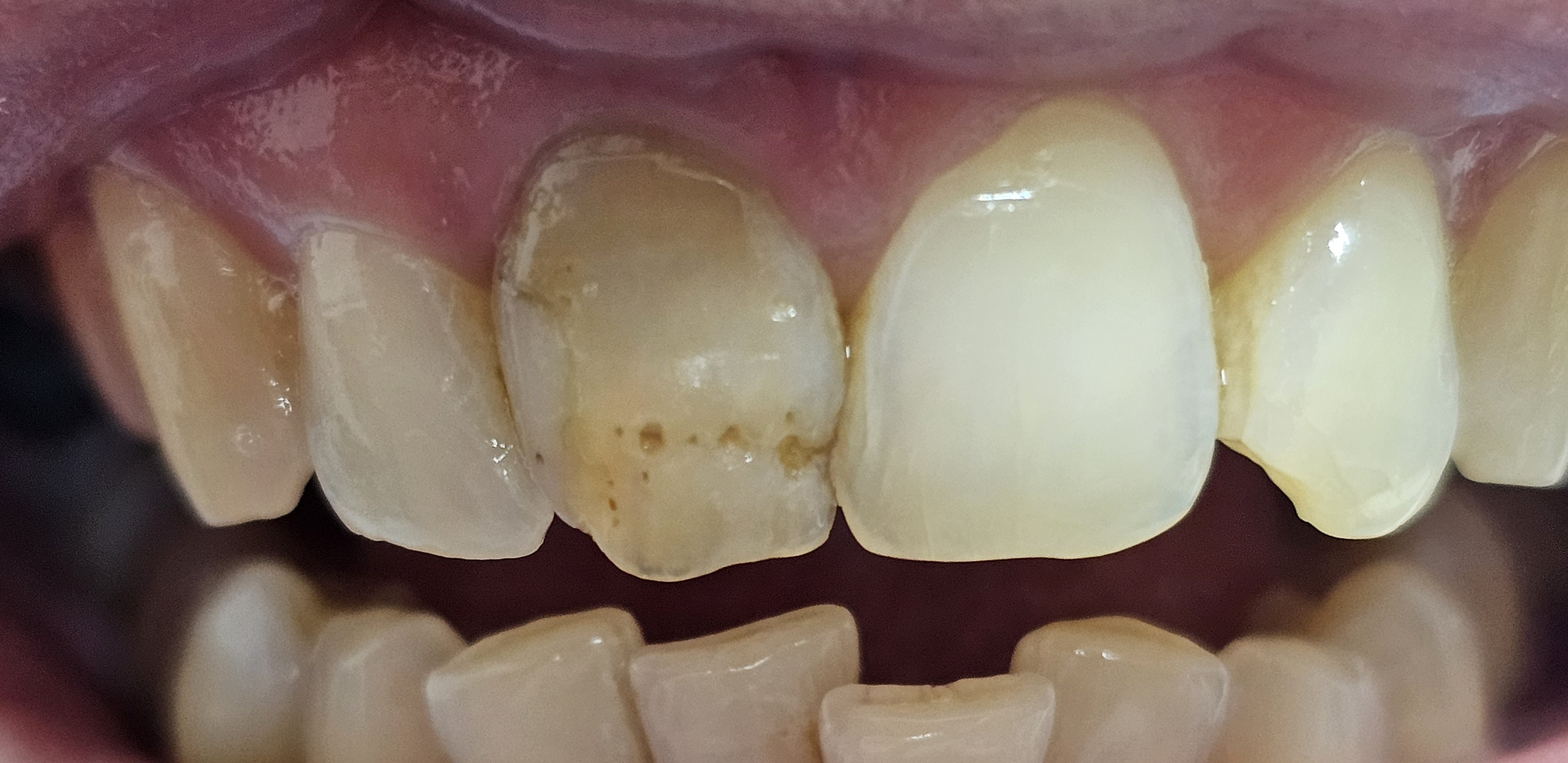 Coroane metalo-ceramice București Sector 1 - înainte CadTech Dental