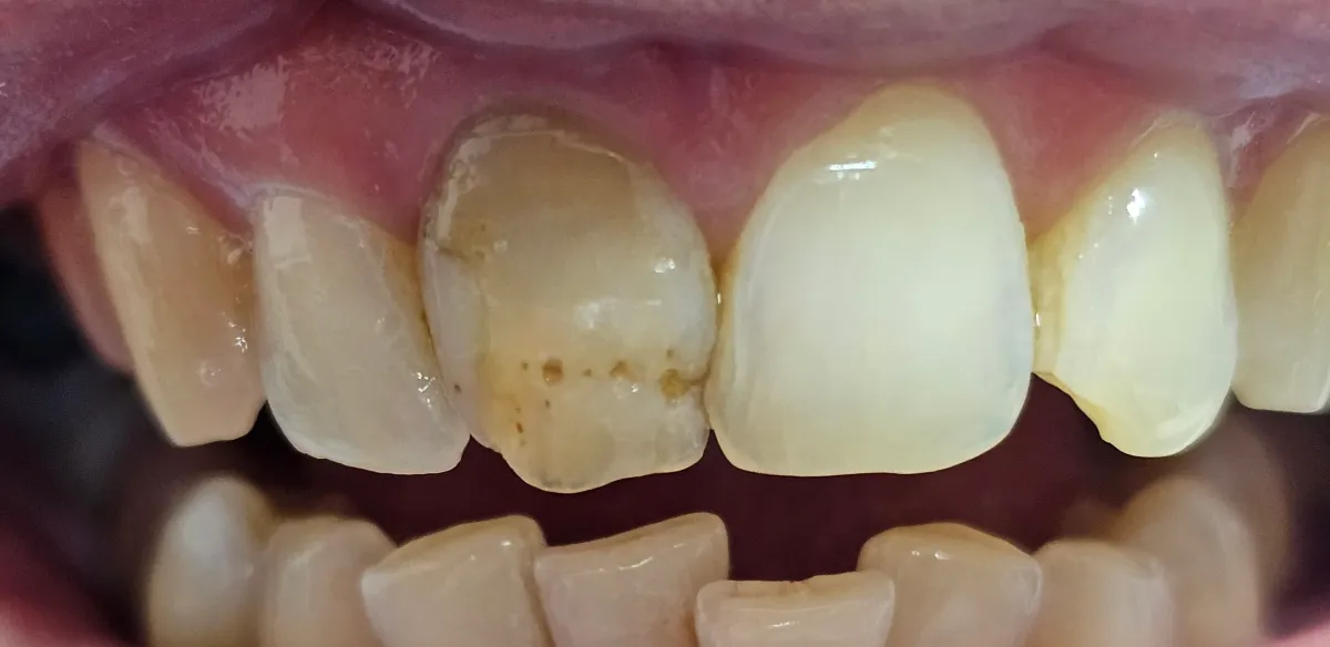 Coroane metalo-ceramice București Sector 1 - înainte CadTech Dental