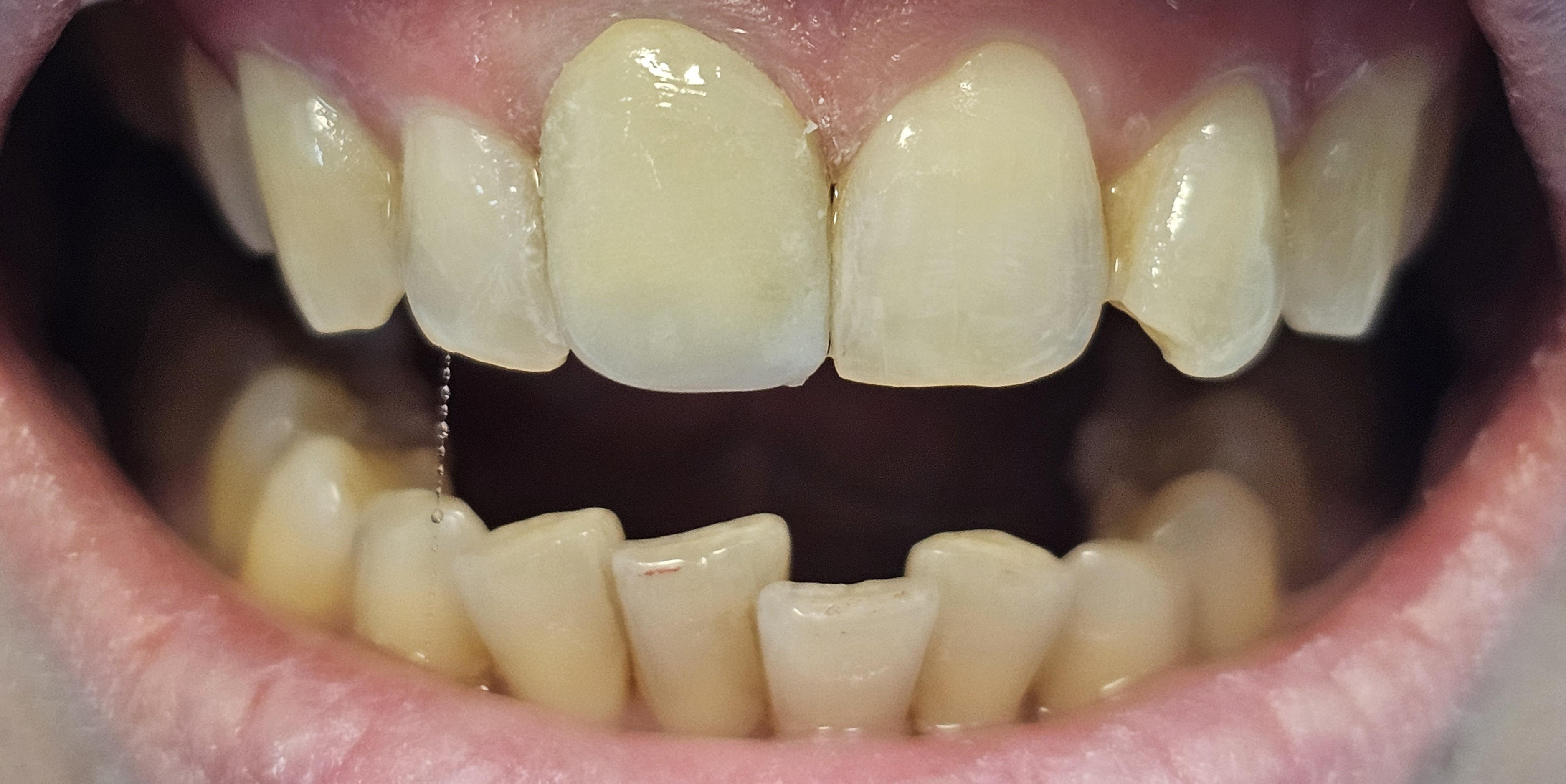 Coroane metalo-ceramice București Sector 1 - după CadTech Dental