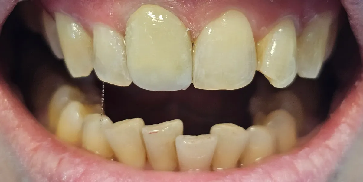 Coroane metalo-ceramice București Sector 1 - după CadTech Dental