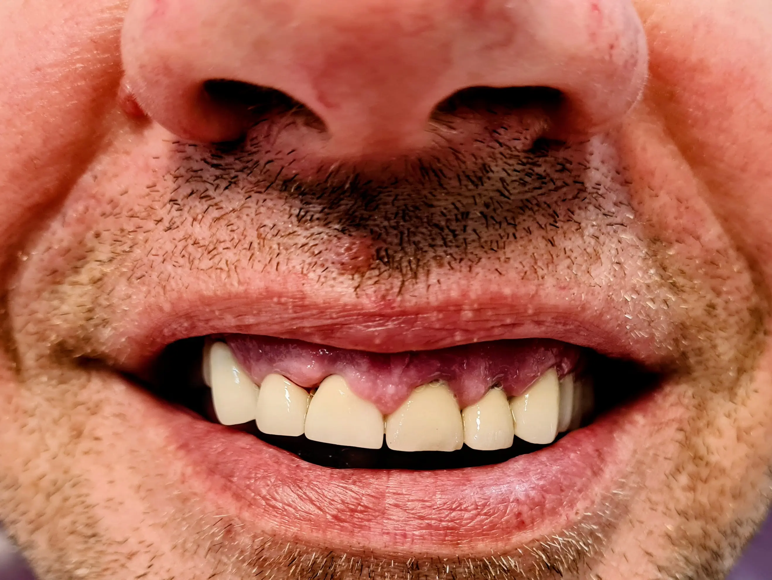 Coroane dentare înainte - CadTech Dental București