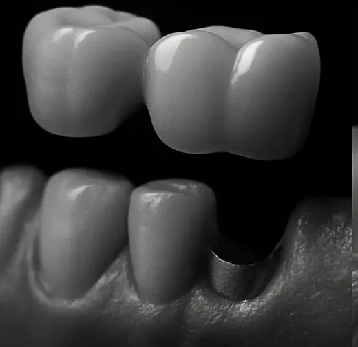 Endodonție București Sector 1 - Tratamente de canal CadTech Dental