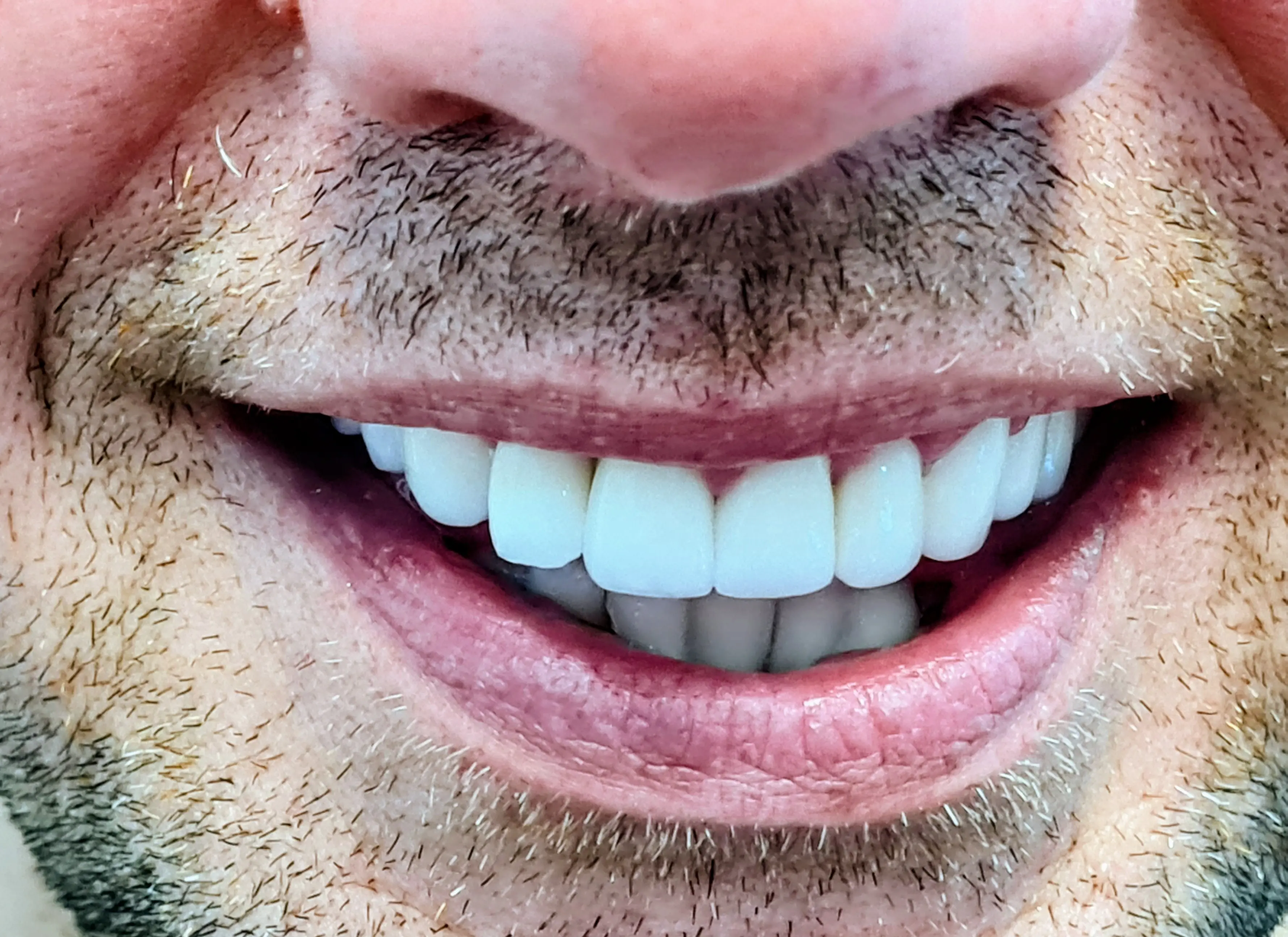Coroane dentare după - rezultat CadTech Dental