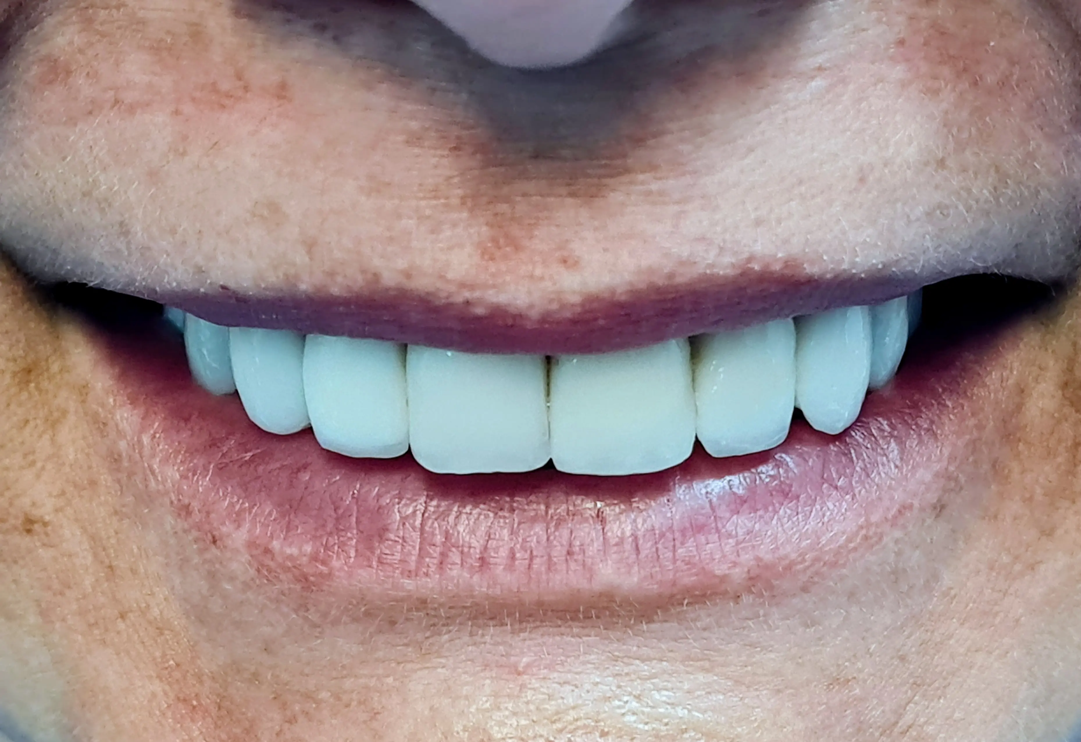 Ortodonție după - rezultat CadTech Dental