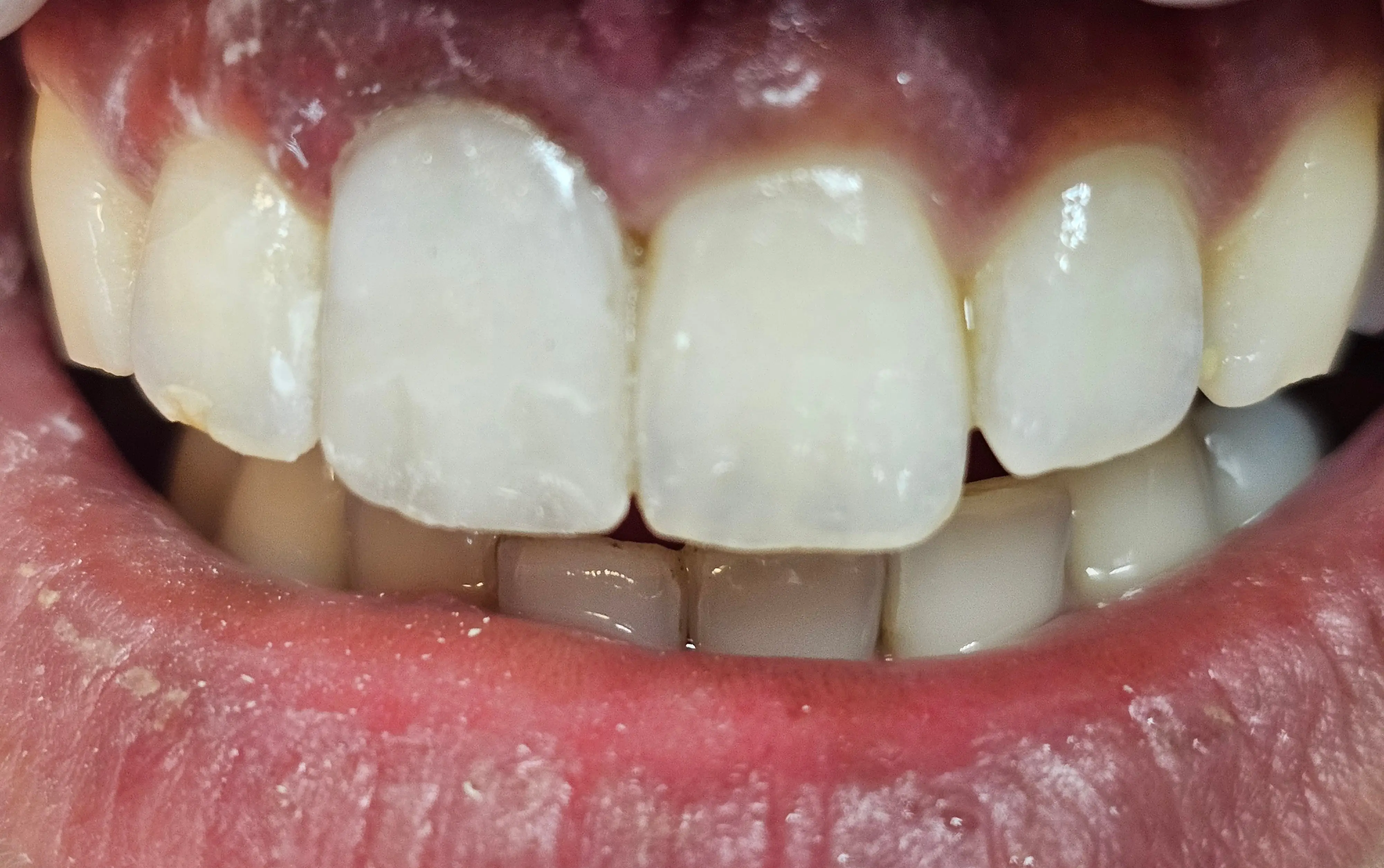 Implant dentar după - rezultat CadTech Dental