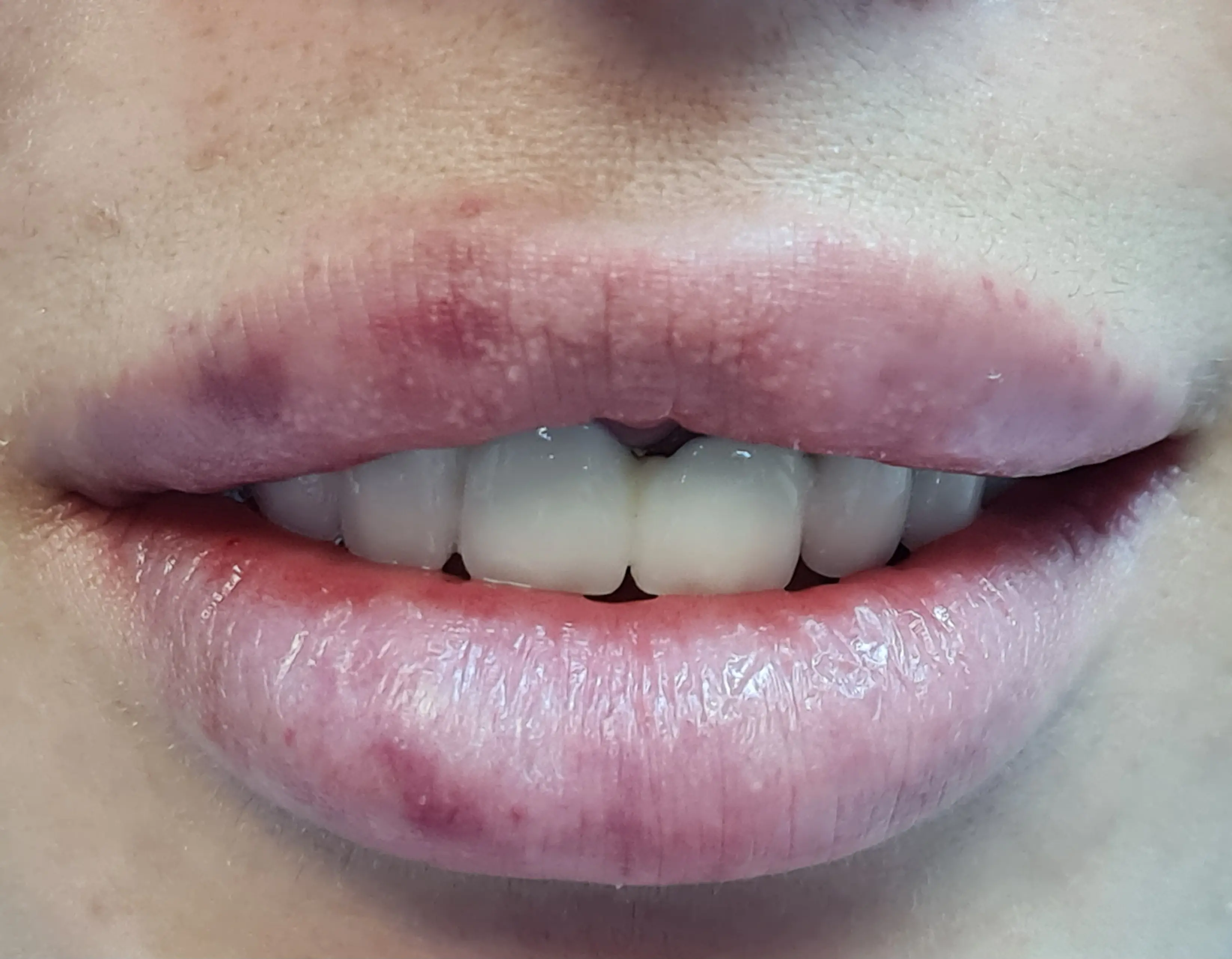 Fațete dentare înainte - CadTech Dental București