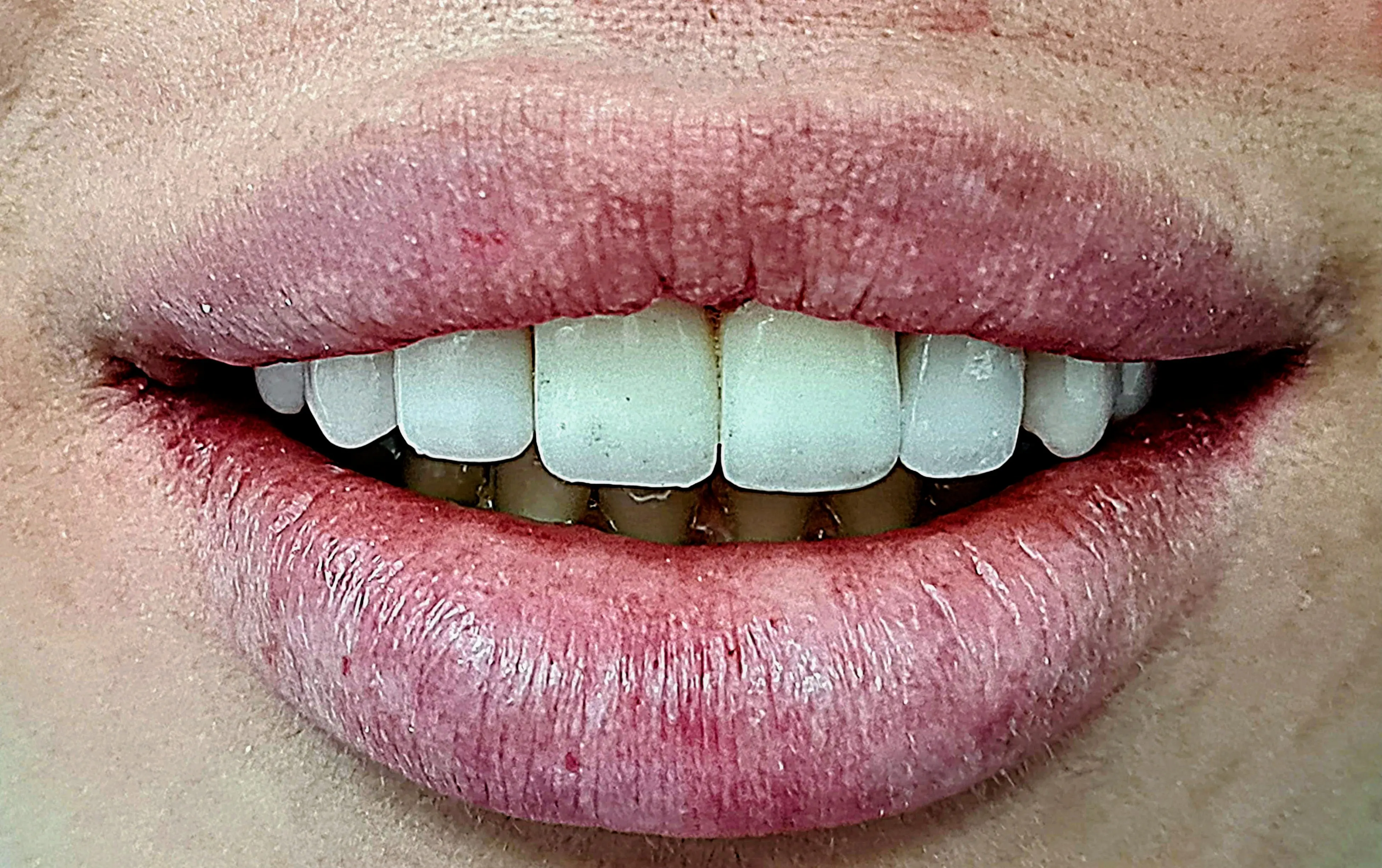 Fațete dentare după - rezultat CadTech Dental