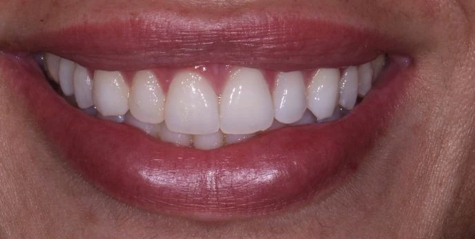 Albire dentară înainte - CadTech Dental București