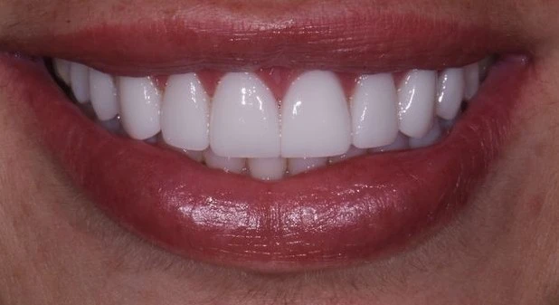 Albire dentară după - rezultat CadTech Dental