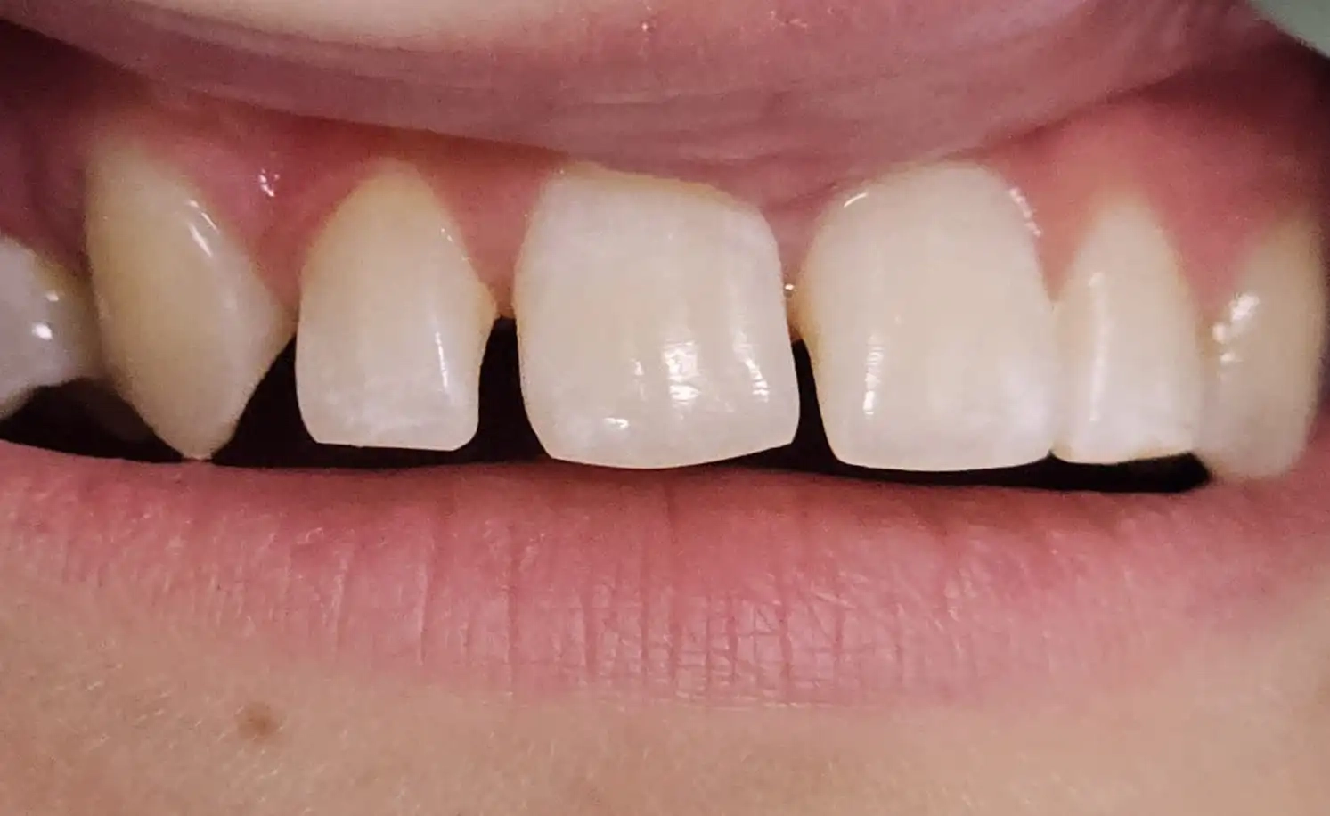 Spațiere dentară inestetică înainte de tratament