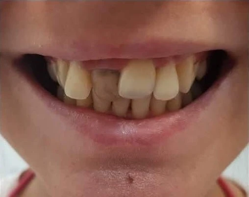 Reabilitare complexă înainte - CadTech Dental București