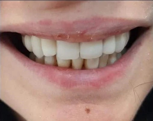 Reabilitare complexă după - rezultat CadTech Dental