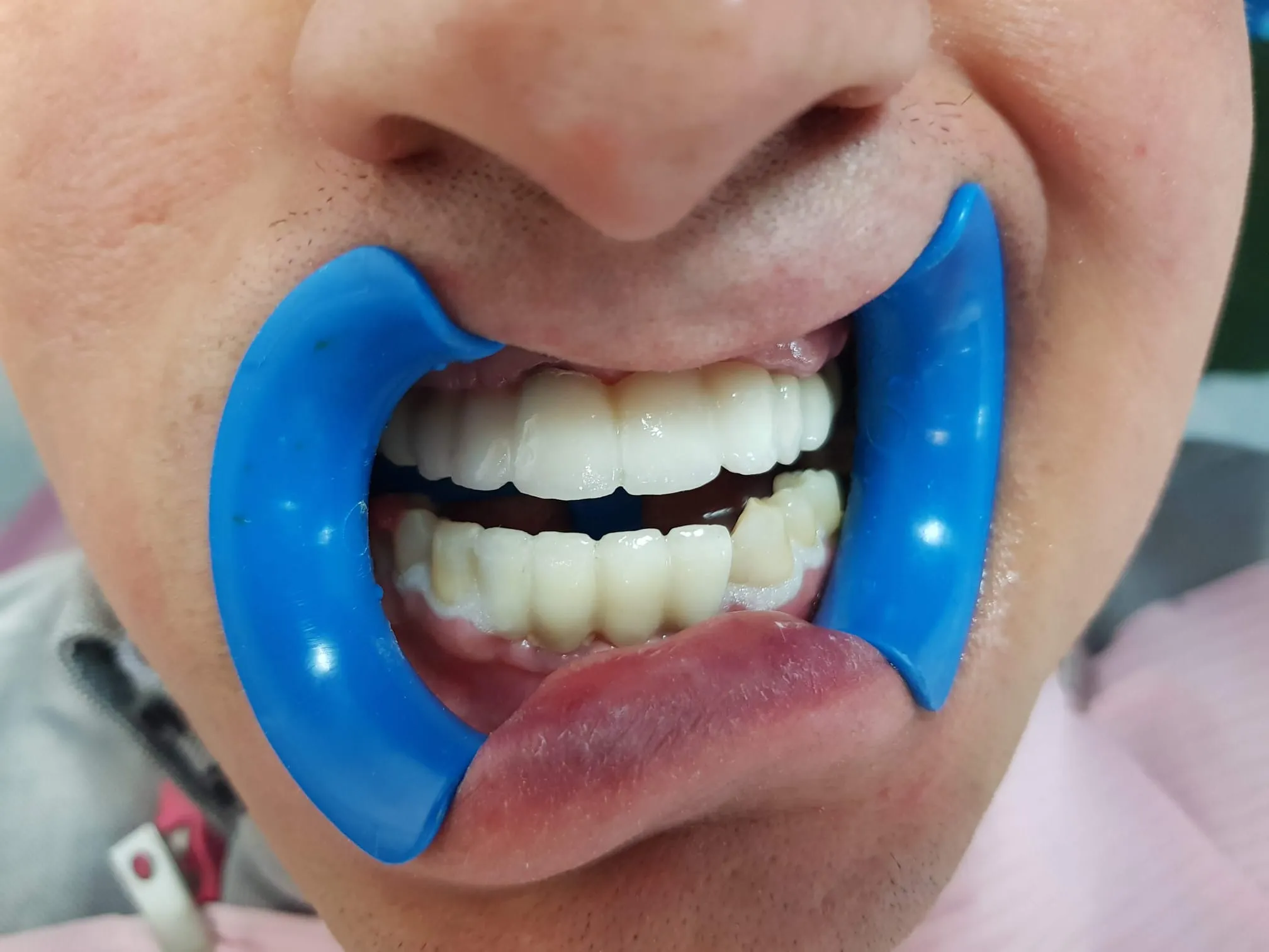 Rezultat final proteză dentară pe implanturi - vedere intraorală
