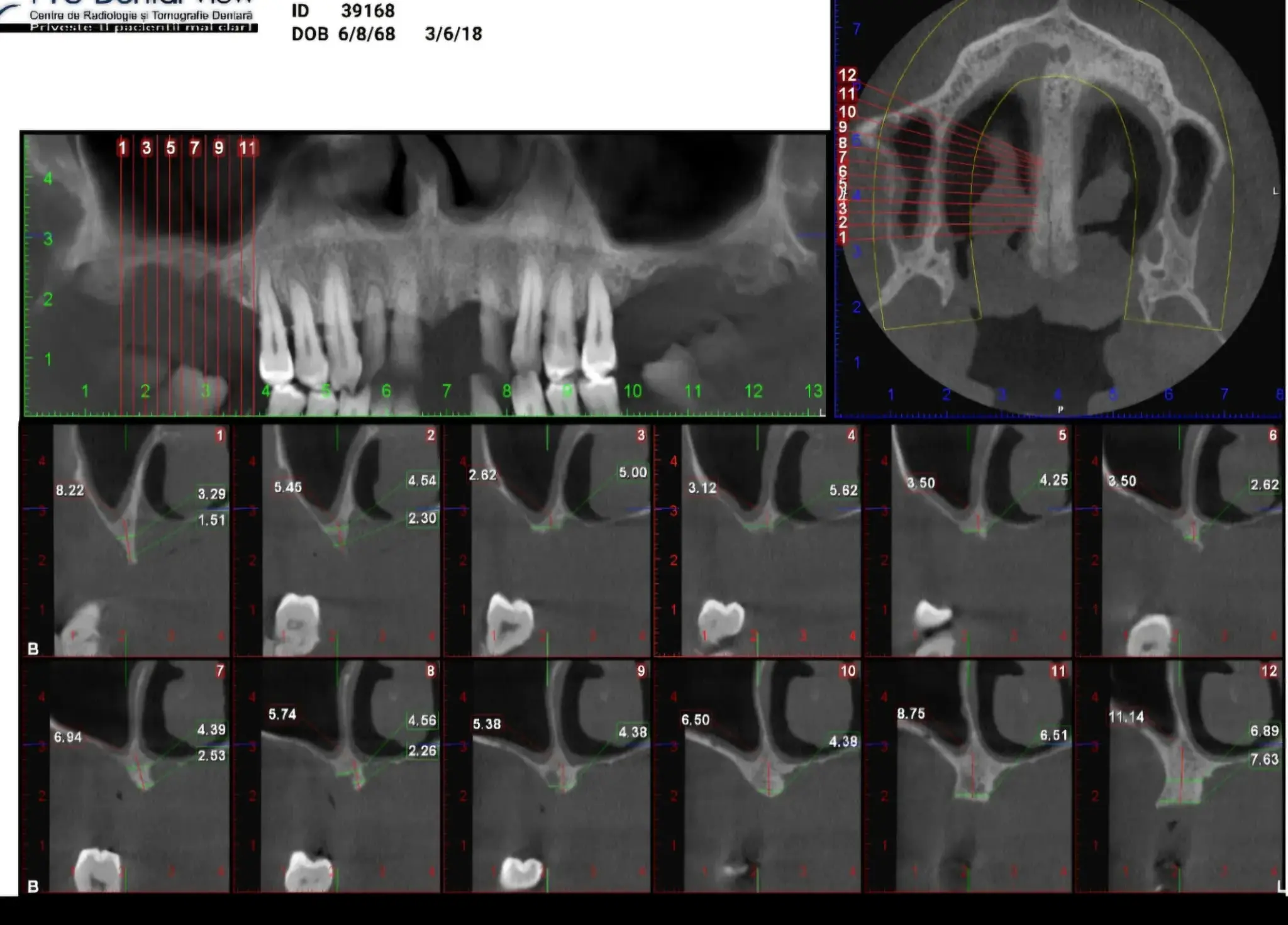 Radiografie panoramică dentară - evaluare pierdere osoasă maxilar și mandibulă