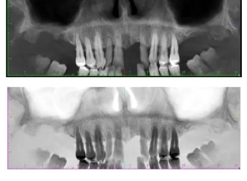 Radiografie dentară laterală - evaluare implanturi și structură osoasă